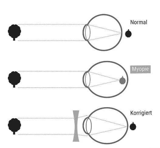 Castelberg Myopie Schema schwarz weiss.jpg